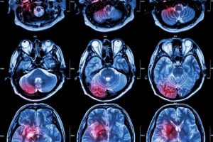 Anayses of post-stroke cognitive decline shines new light